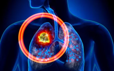 Ogólne informacje na temat zaleceń żywieniowych u pacjentów z rakiem płuc